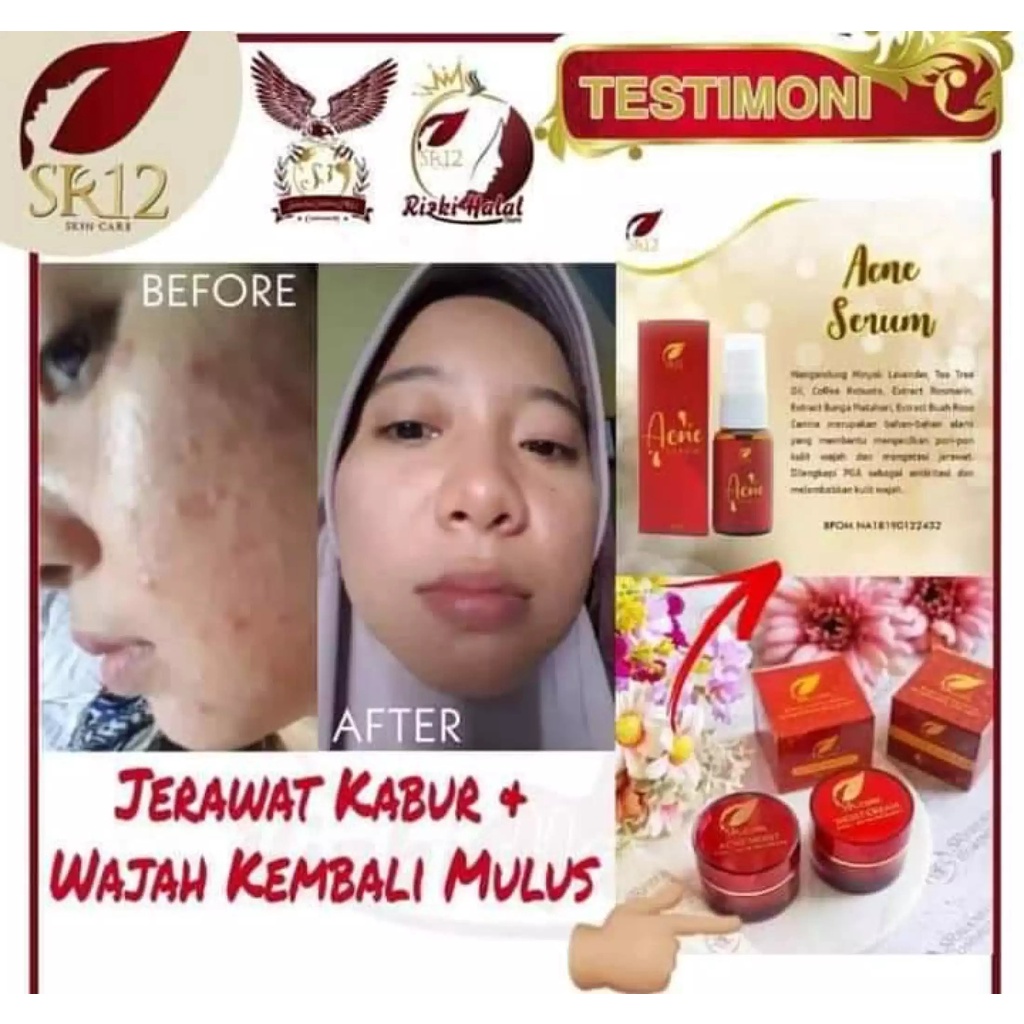 Skincare Wajah Berjerawat BPOM | Acne Series SR12 Skincare | Acne Moist | Acne Totol | Acne Serum | Acne Toner | Solusi Ampuh Atasi Jerawat | Menghilangkan Jerawat dan Bekas Jerawat | Krim Jerawat | Jerawat Bruntusan | Jerawat Batu | Jerawat Membandel