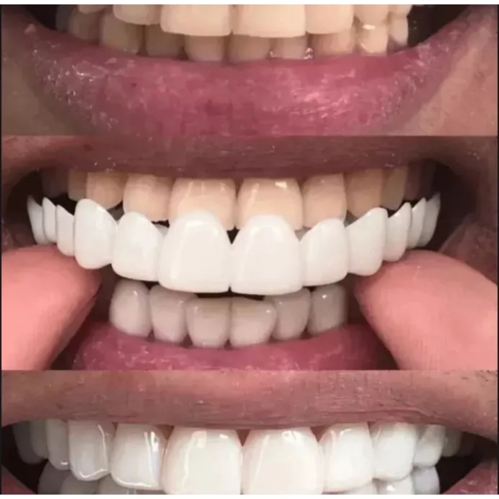 Gigi palsu instan atas bawah