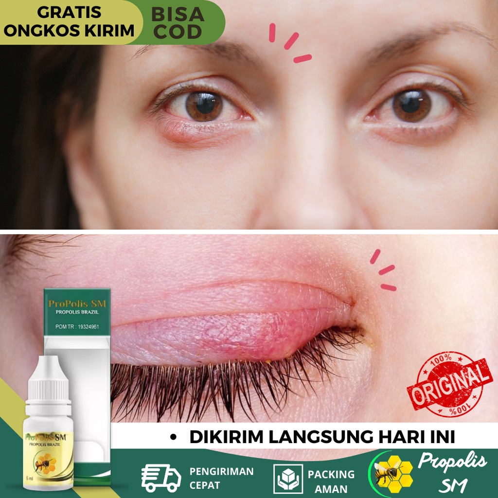 Obat Mata Kalazion, Obat Kelopak Mata Bengkak, Obat Mata Bintitan, Obat Peradangan Kelopak Mata, Oba