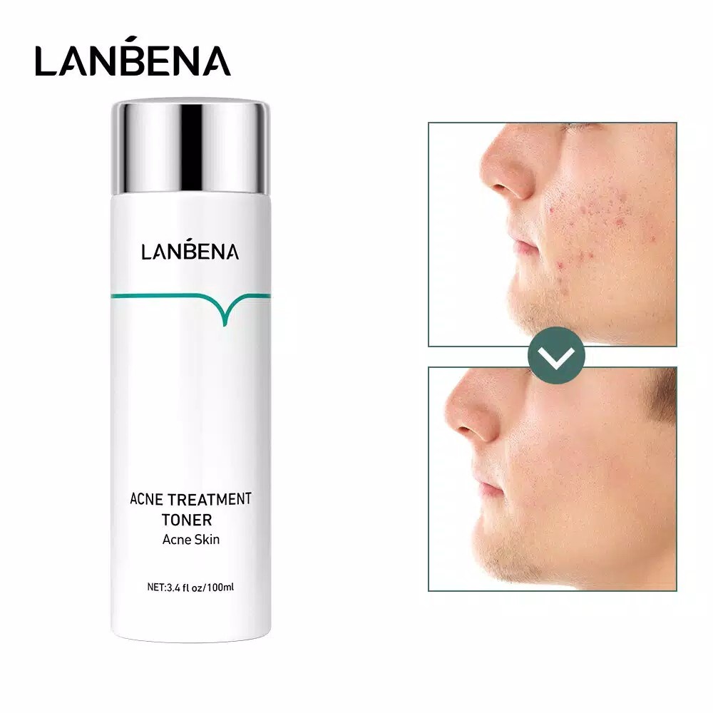 (READY &amp; ORI) LANBENA ACNE TREATMENT TONER ACNE SKIN LB5744 PENYEGAR WAJAH MENCERAHKAN