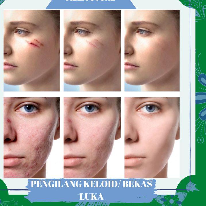 ❁ Salep obat krim cream penghilang menghilangkan bekas luka keloid luka bakar sesar lama ⇘