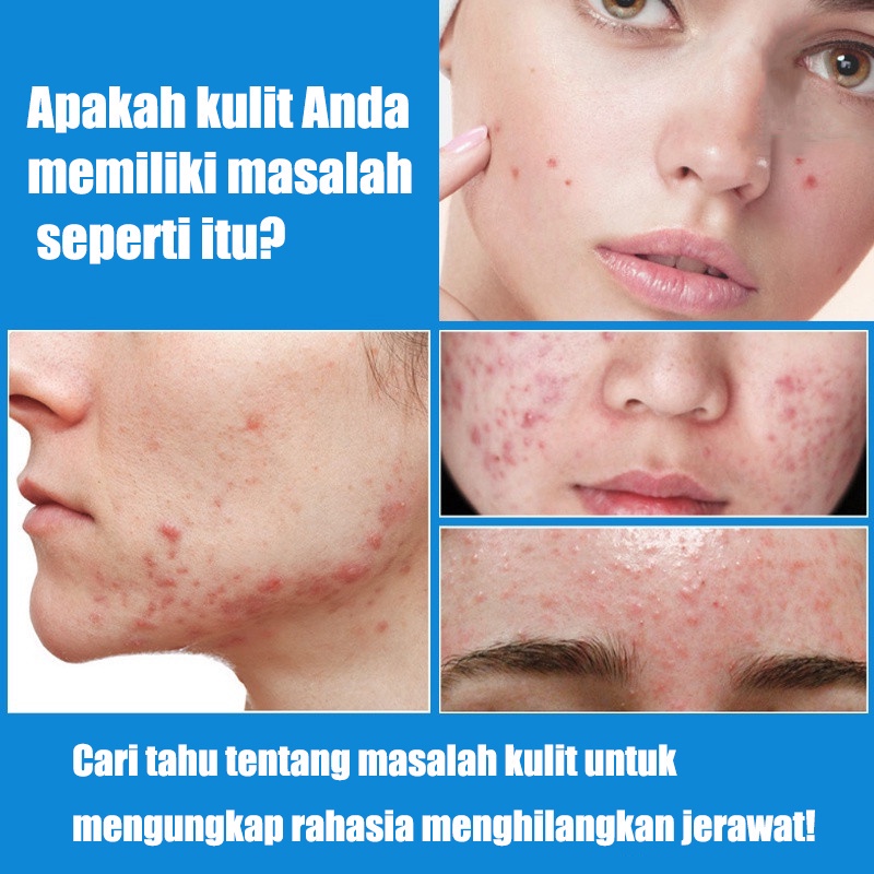 cream jerawat krim jerawat Acne treatment Cream  jerawat Obat jerawat Penghilang bekas 30g jerawat Memudarkan jerawat Serum acne Krim jerawat Krim penghilang jerawat