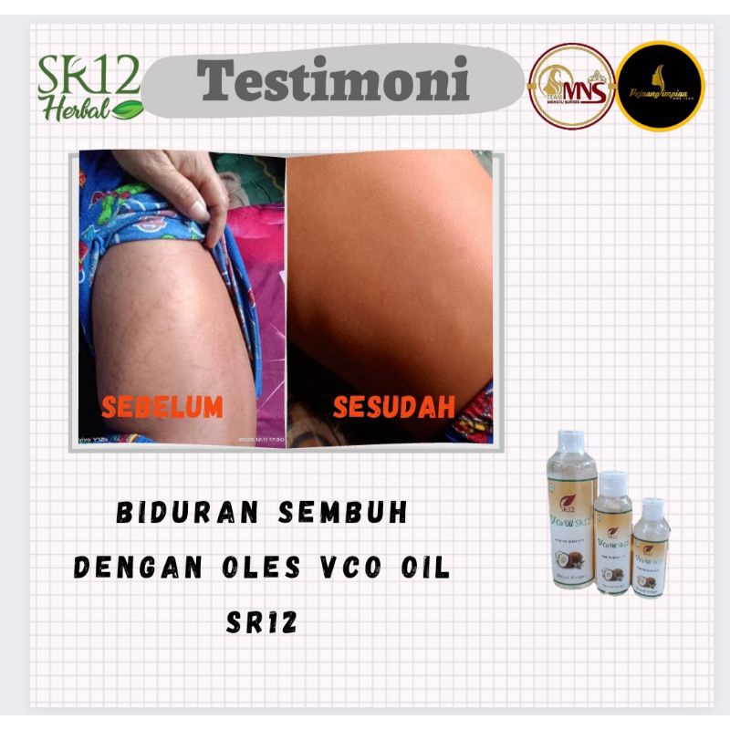 sr12 Obat Biduran Ampuh Vco Oil