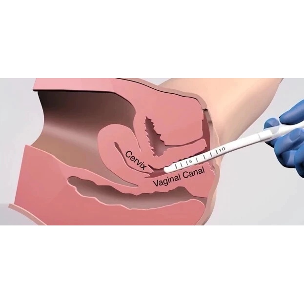 probe rf vaginal thermiva comsumable