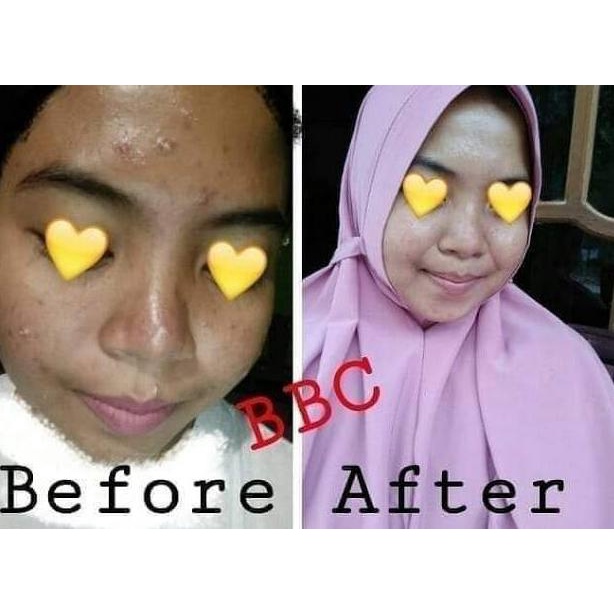 ⇂ BEBWHITE C ACNE SERIES / BBC SKINCARE/ CREAM BBC 𝕷