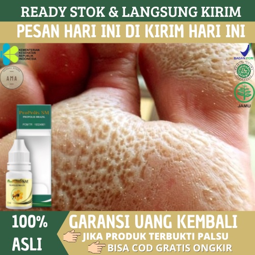 Jual Obat Kaki Rayapan Obat Kaki Rayapan Dan Bau Obat Telapak Kaki