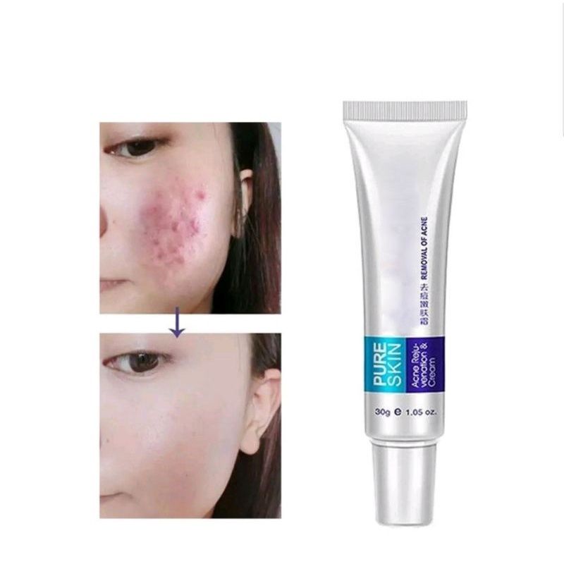 [ ORIGINAL ] Obat Penghilang Jerawat Dan Bekas Jerawat Ampuh Pure Skin Cleanser Cream Acne