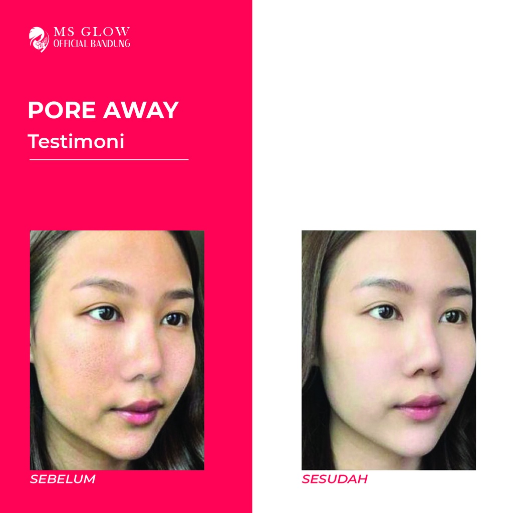 Pore Away MS Glow Perawatan Wajah Spot Treatment Berkualitas Termurah - By Msglowofficialbandung