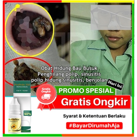 Jual Obat Hidung Bau Busuk | Penghilang Polip, Sinusitis, Polip Hidung
