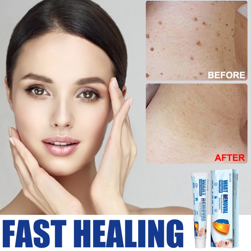 EELHOE Wart Removal Cream Repair dan Clean Skin Tag Remover 20gr - Menghilangkan Kutil Tahi Lalat Mata Ikan