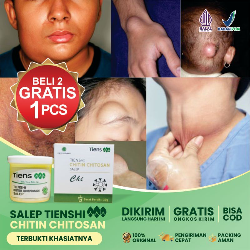 (SALEP OLES PENGHILANG BENJOLAN LIPOMA BELI 2 GRATIS 1)