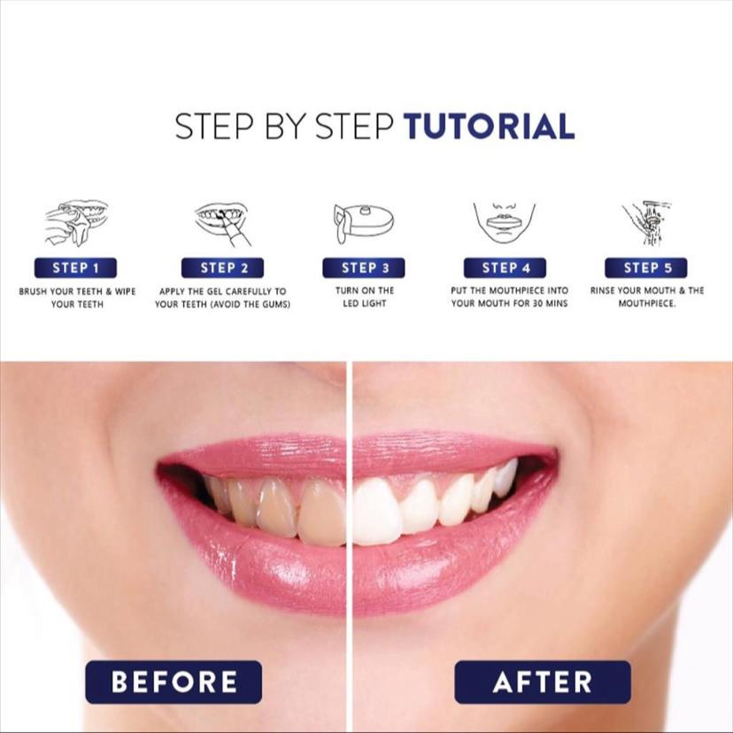 PRO TEETH WHITENING KIT Alat Pemutih Gigi Permanen | Beaudelab Memutihkan Gigi Super Cepat