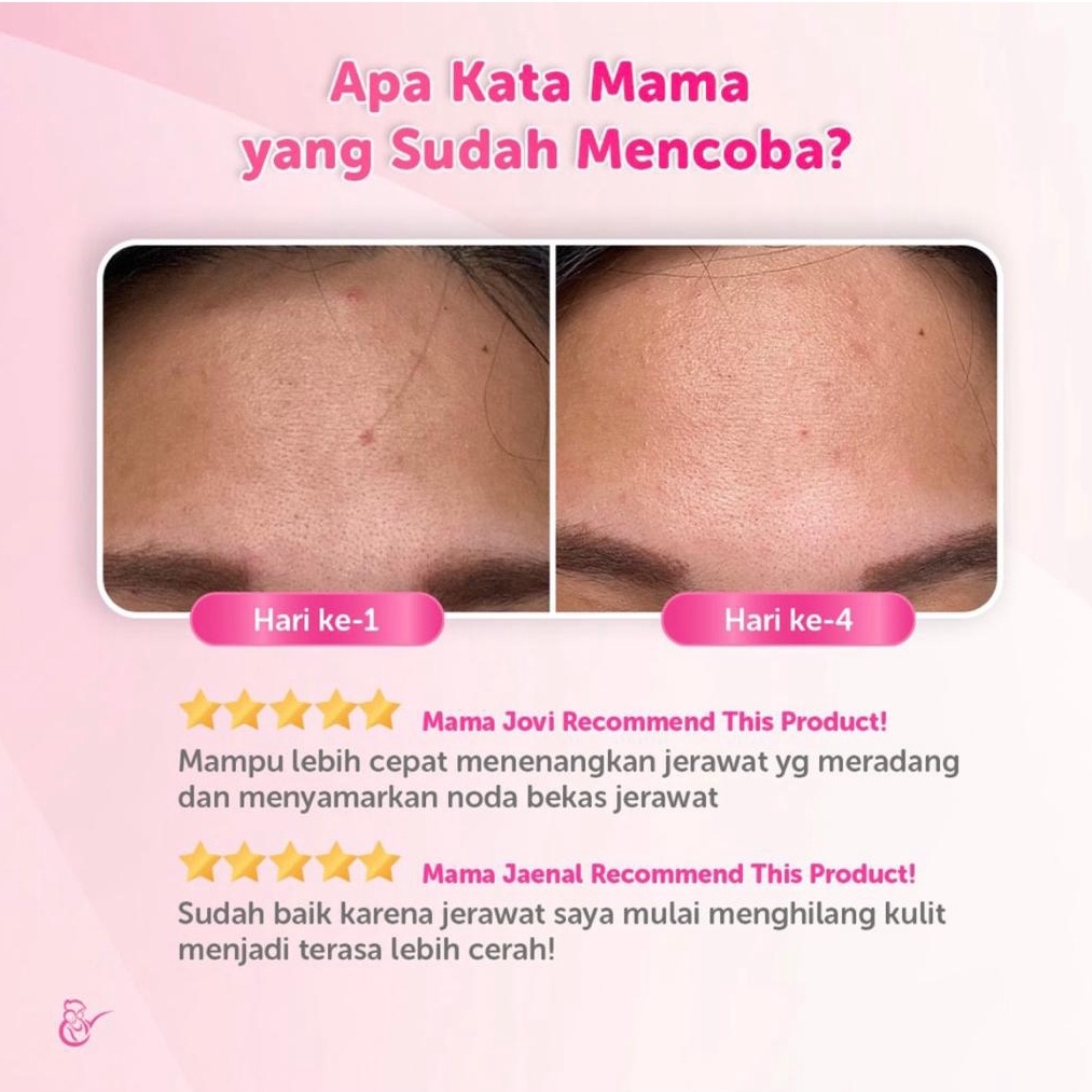 Mama's Choice Serum Anti Jerawat - Anti-Acne Face Serum  (Aman untuk Ibu Hamil dan Menyusui)