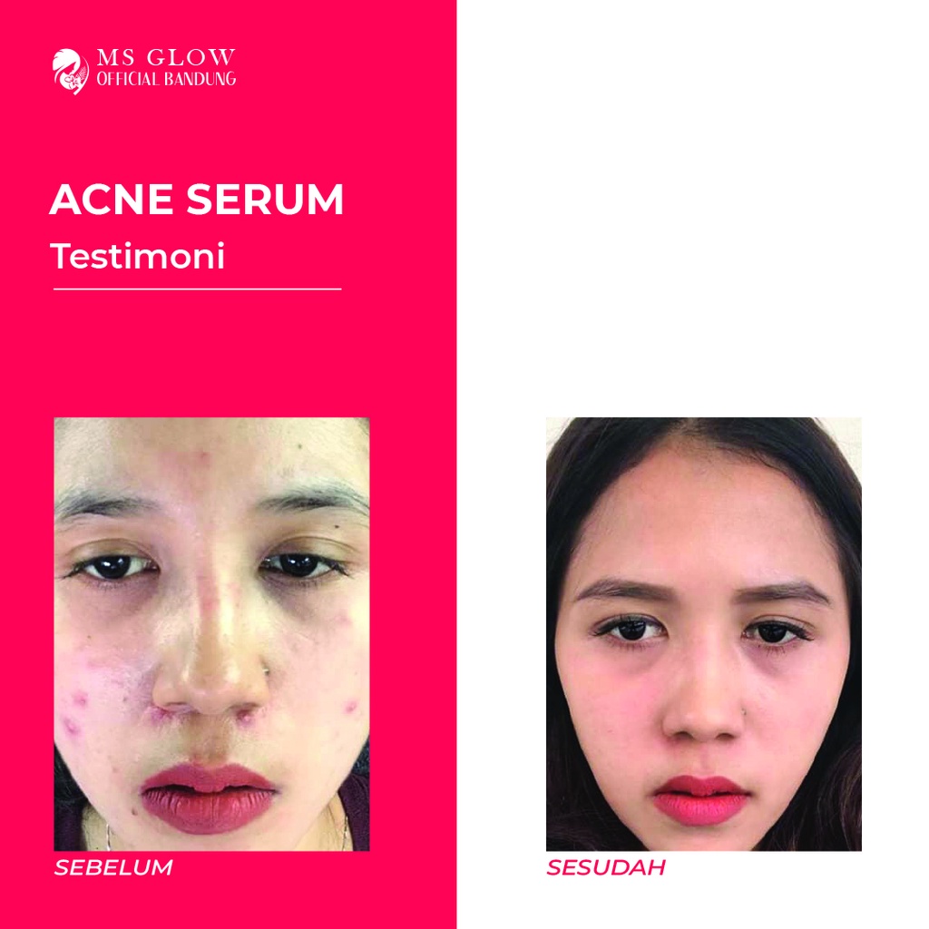 Acne Serum MS Glow / Pelembab Wajah / Obat Jerawat Termurah Berkualitas - By Msglowofficialbandung