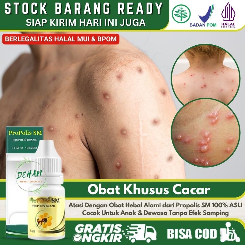 Salep Untuk Cacar Air, Cacar Api, Cacar Monyet, Atasi Bentol - Bentol Merah di Sertai Gatal Menahun,