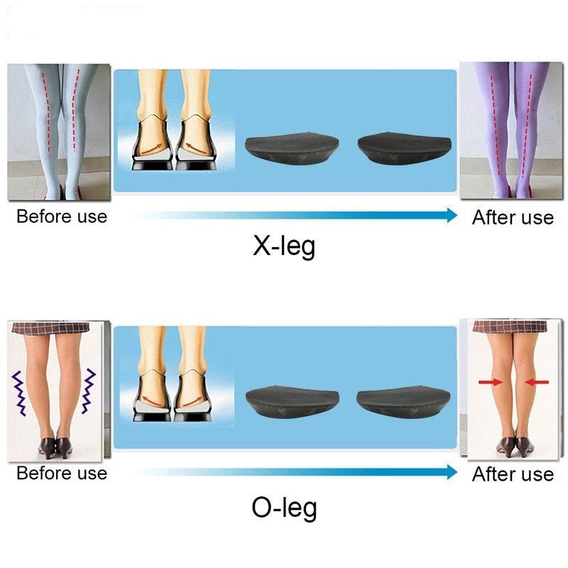 Silicone Insole For Supination &amp; Pronation / Korektor Kaki X&amp;O / Alat Terapi / Valgus / Varus / Terapi Kaki X / Terapi Kaki O