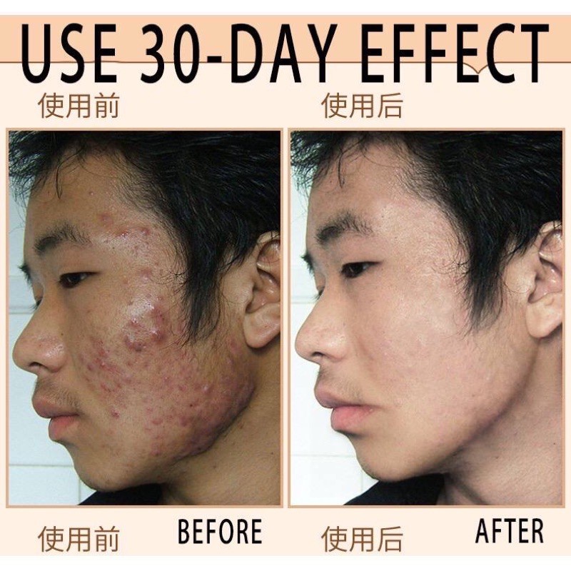 cream jerawat krim jerawat Acne treatment Cream  jerawat Obat jerawat Penghilang bekas 30g jerawat Memudarkan jerawat Serum acne Krim jerawat Krim penghilang jerawat