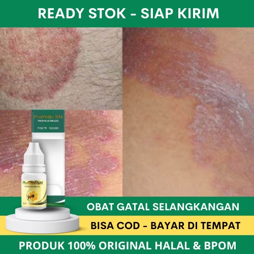Obat Gatal Selangkangan, Obat Selangkangan Menghitam dan Gatal, Obat Jamur Selangkangan, Obat Babak,