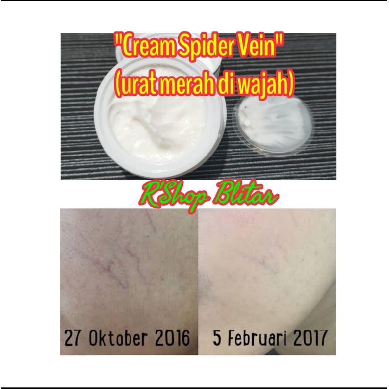 Cream spider vein - krim spider ven - krim urat merah biru di wajah
