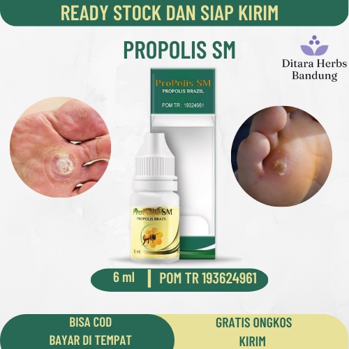 Obat Mata Ikan, Obat Mata Ikan Di Telapak Kaki, Obat Tetes Mata Ikan, Obat Perontok Mata Ikan, Obat 