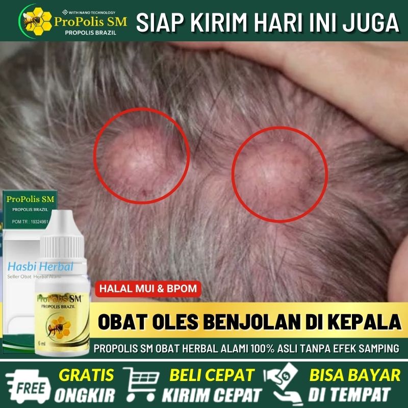 Salep Benjolan di Kepala, Pengempis Benjolan Abnormal di Kepala, Obat Oles Benjolan di Kepala 100% H