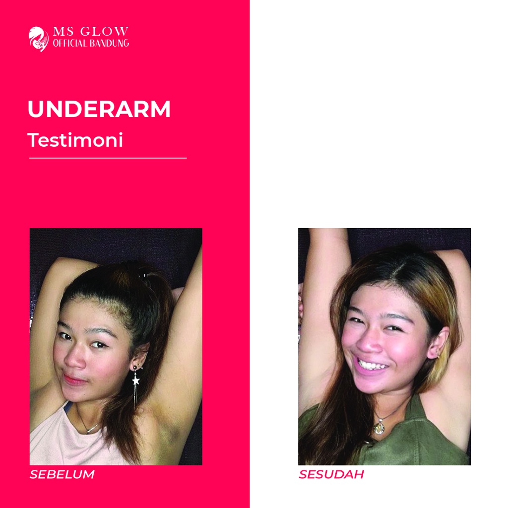 Underarm Cream MS GLow / Pemutih / Pencerah Ketiak Termurah Berkualitas By Msglowofficialbandung