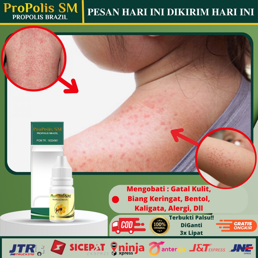 Jual Obat Herbal Biang Keringat Gatal Pada Kulit Alergi Bintik Bintik Di Badan Ruam Merah 5354