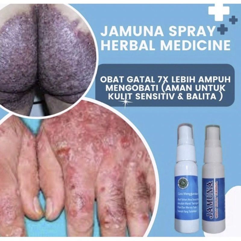 OBAT ALERGI GATAL KULIT PALING AMPUH HERBAL JAMUNA | SPRAY ISI 25ML | OBAT GATAL