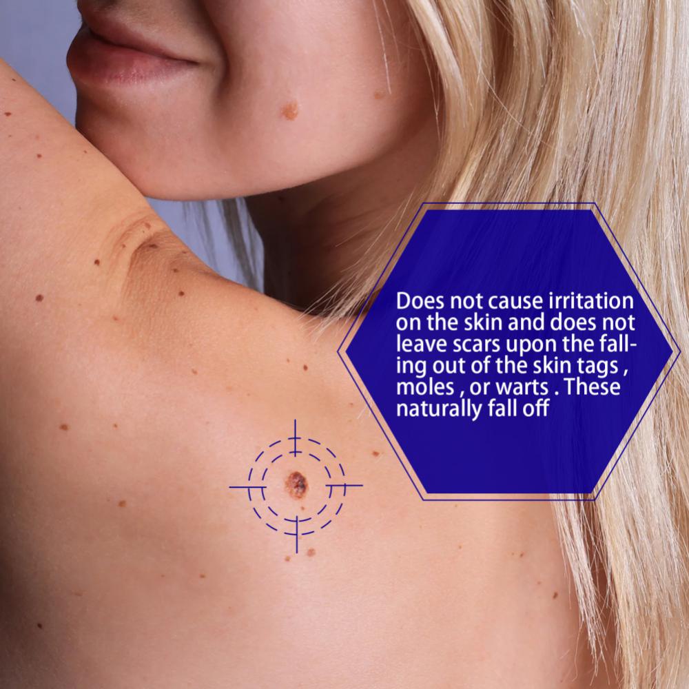 【20 gr】Skin Tag Remover Cream/Salep Obat Penghilang Tahi Lalat dan Kutil/Krim Pengilang Kutil/Wart Removal Cream