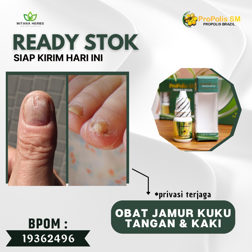 Mitana Herbal - Obat Jamur Kuku Tangan - Obat Jamur Kuku Kaki - Obat Kuku Berjamur - Obat Cantengan 