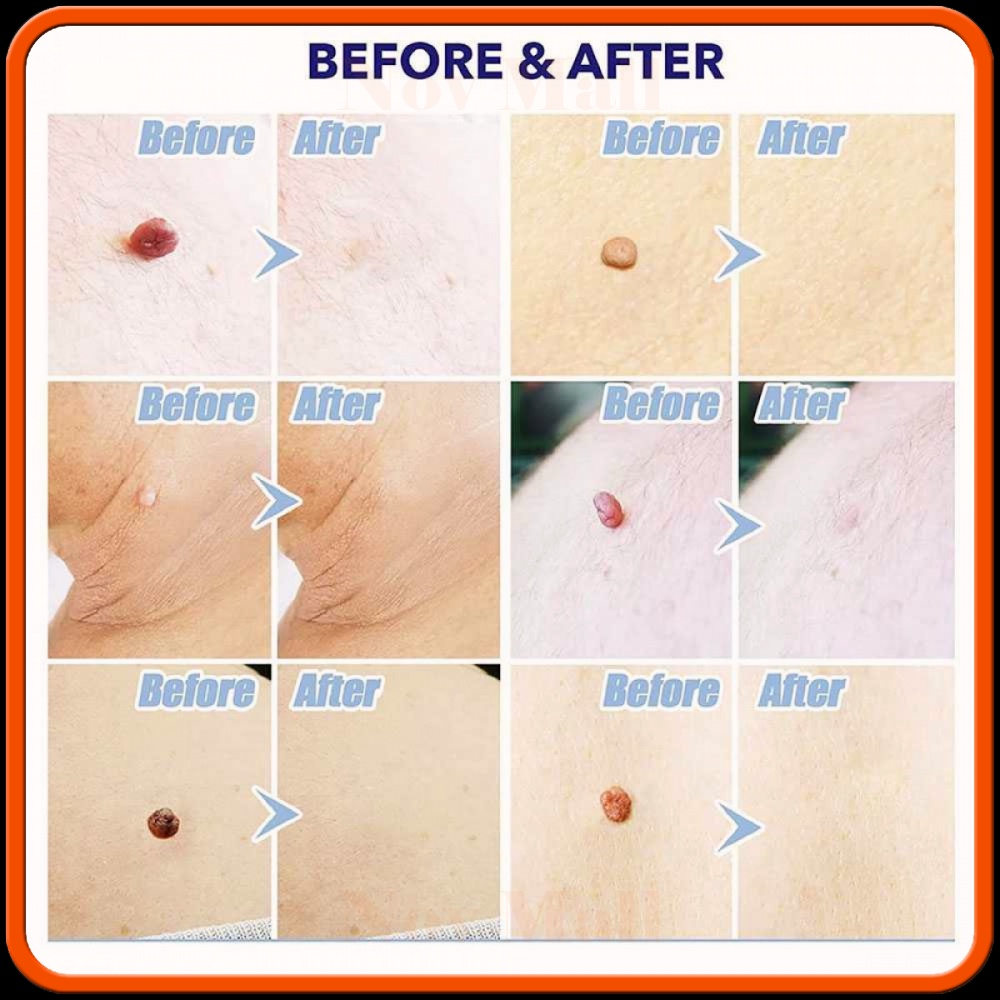Alat Penghilang Kutil Painless Skin Tag Mole Removal Kit -BY006