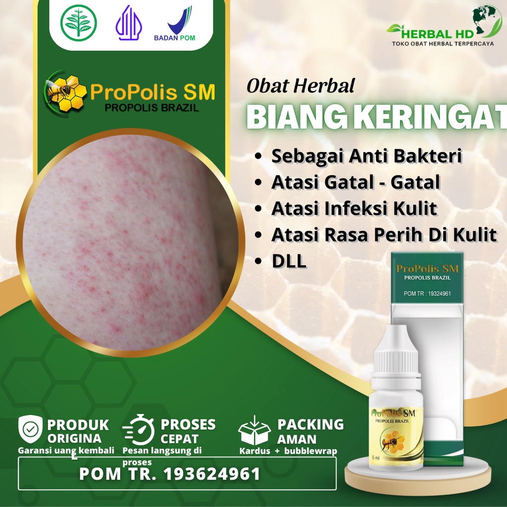 Obat Biang Keringat - Biang Keringat Pada Bayi - Pada Wajah - Obat Eksim Kering - Obat Eksim Basah -