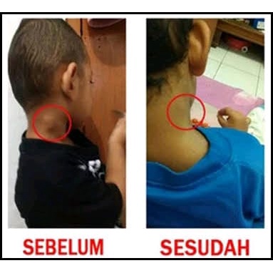 ( TERLARIS ) SALEP KHUSUS BENJOLAN AR-RAIHAN - MENGOBATI BENJOLAN - GONDOK - TUMOR - obat kista - benjolan kista - Baahirah - minyakBaahirah - salep benjolan lipoma - salep untuk mengatasi benjolan lipoma - salep terbaik