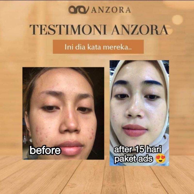 ANZORA REMOVER ACNE DARKSPOT