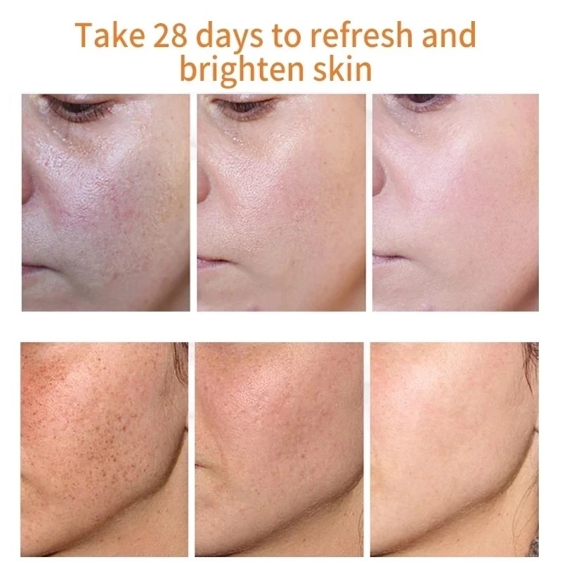 Whitening Freckle Cream Remove Dark Spots Anti Freckle Cream Niacinamide Fade Pigmentation Melasma Brighten Creams concealer