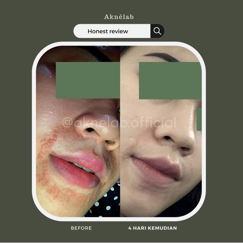 Anti Iritasi Series Aknèlab (1 paket) menyembuhkan iritasi pada kulit wajah