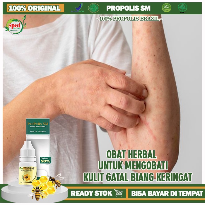 Obat Biang Keringat Kulit Gatal, Obat Biang Keringat Di Leher, Biang Keringat Tubuh Gatal Gatal, Oba
