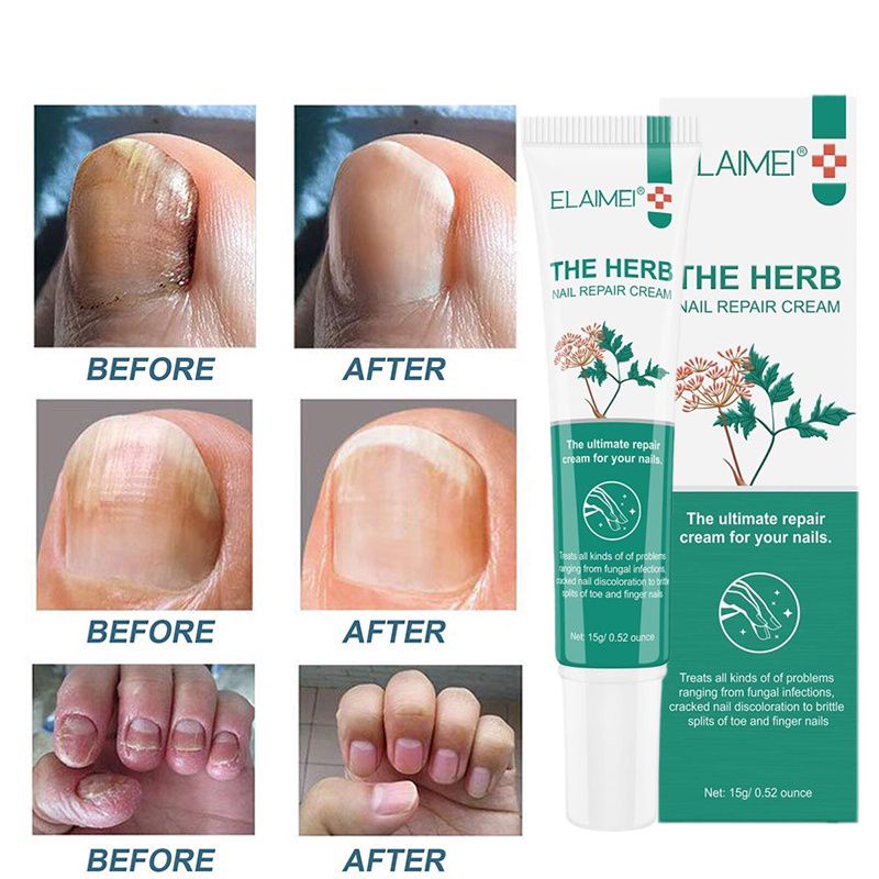 Elaimei Nail Repair Cream Jamur Kuku, Kuku Rusak, Dan Mengobati Masalah Pada Kuku