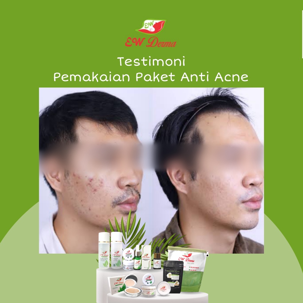 Obat Jerawat Pria Bopeng Bekas Jerawat Komedo Flek Hitam Cream Pemutih Cowok BPOM