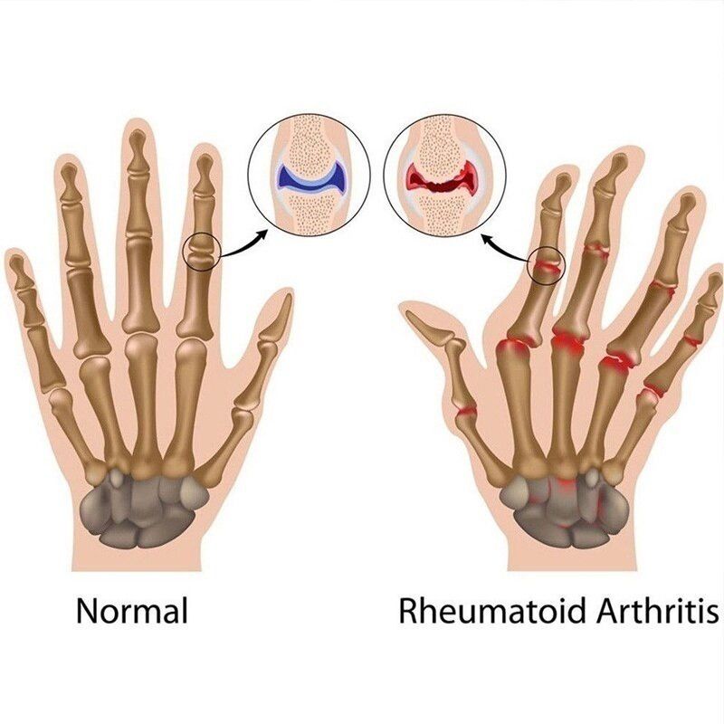 Sarung Tangan Terapi Arthritis Glove Therapy/ reumatik / kebas