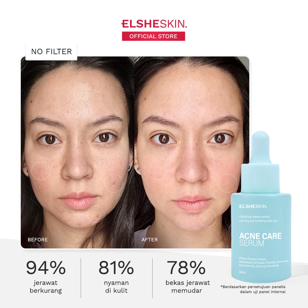 ❤ MEMEY ❤ ElsheSkin Acne Care Serum 15ml 30ml