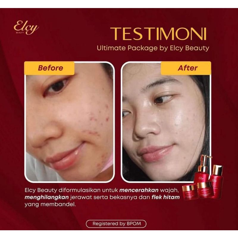 ELCY BEAUTY LC BEAUTY PAKET JERAWAT 100X LEBIH CEPAT MENGHILANGKAN JERAWAT