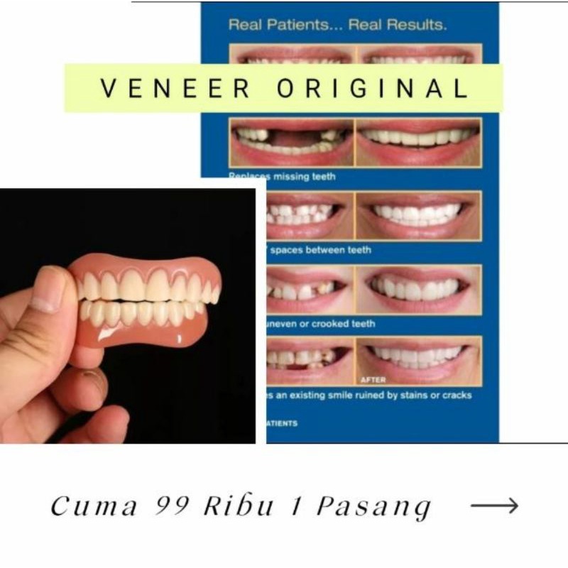 Veneer gigi