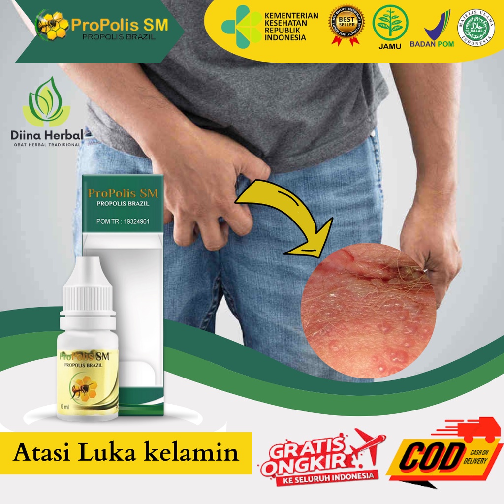 Obat Balanitis Luka Lecet di Kepala Penis, Obat Gatal Kemaluan Pria, Obat Gatal Kelamin Pria, Obat P