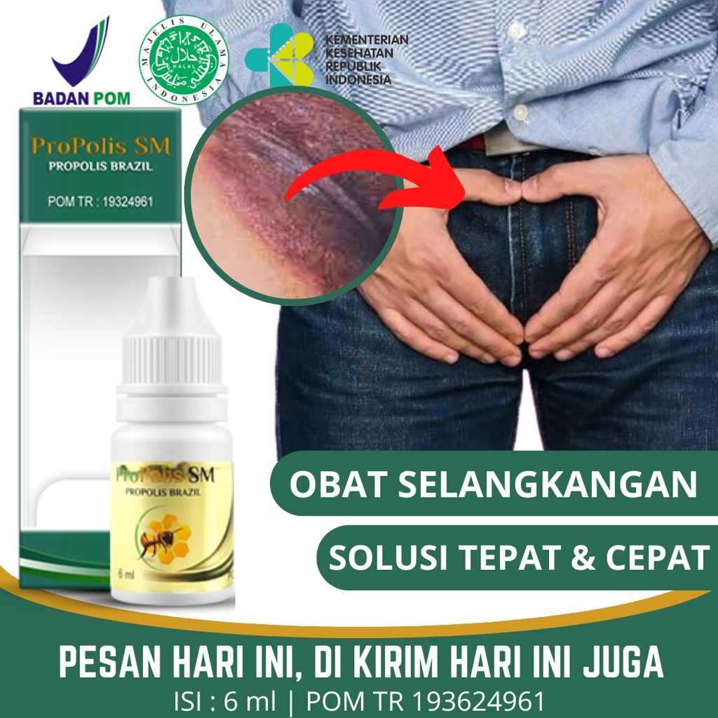 Obat Gatal Selangkangan, Selangkangan Gatal Dan Hitam, Eksim Kering Menahun, Biduran, Gatal Pada Kul