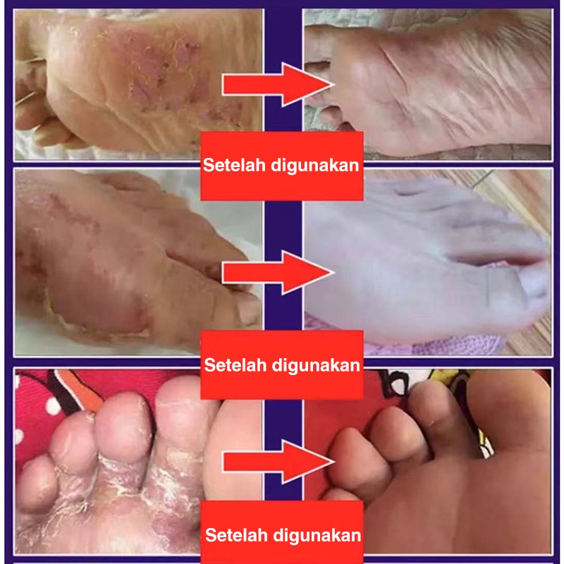 Obat Telapak Kaki Rayapan Kaki Rayapan Kaki Rayap Bau 20g Kaki Bolong Bolong Seperti Kena RayapTumit Kaki Pecah Telapak Kaki Rayapan Penghilang Kaki Rayapan Kaki Bolong Bolong Kaki Bolong Telapak Kaki Bolong, Telapak Kaki Bolong Bolong