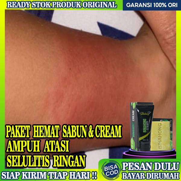Obat Selulitis Ringan Cream 20 gram dan Sabun Binahong 100 gram Obat Gatal Kulit Eksim Alergi,Obat B
