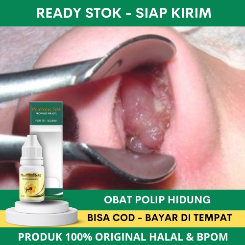 Obat  Polip Hidung, Polip Akut, Polip Kronis, Benjolan di Hidung, Polip Hidung Bengkak, Daging Jadi 