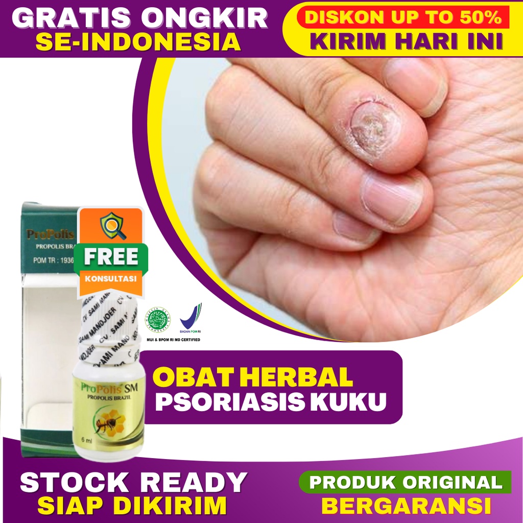 Obat Psoriasis Kuku Nyeri Kuku Kering Kuku Menebal Kuku Rusak Jamur Kuku Penyakit Autoimun Propolis 