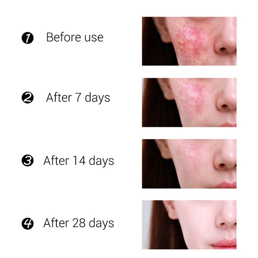 [BPOM] BREYLEE Acne Treatment Cream - Krim Jerawat